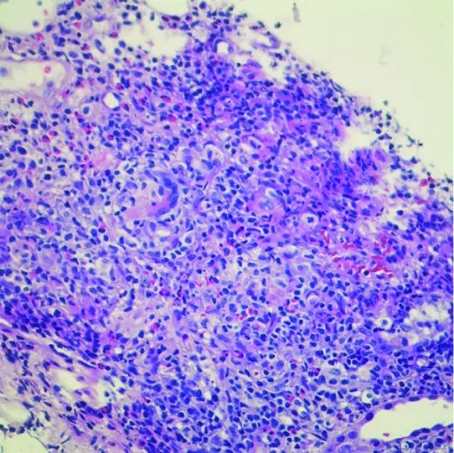 Acute Drug-Induced Interstitial Nephritis