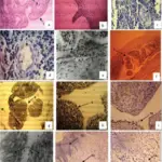 Acute Endometritis