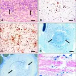 Acute Inflammatory Demyelinating Polyneuropathy (Guillain-Barre Syndrome)