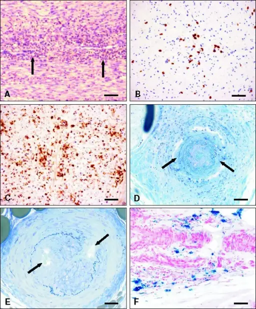 Acute Inflammatory Demyelinating Polyneuropathy (Guillain-Barre Syndrome)