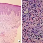 Acute Inflammatory Dermatoses