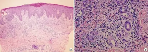 Acute Inflammatory Dermatoses