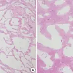 Acute Interstitial Pneumonia