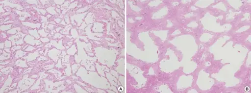 Acute Interstitial Pneumonia