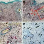 Acute Liver Failure