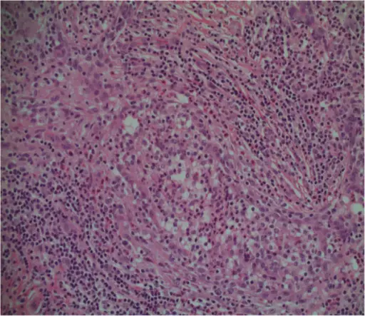 Acute Mastitis