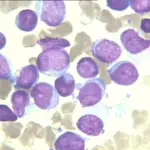 Acute Myeloid Leukemia