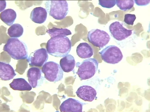 Acute Myeloid Leukemia