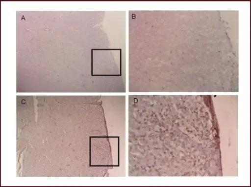 Acute Necrotizing Hemorrhagic Encephalomyelitis