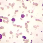 Acute Nonspecific Lymphadenitis