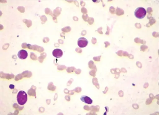 Acute Nonspecific Lymphadenitis