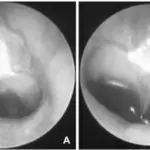 Acute Otitis Media