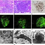 Acute Proliferative Glomerulonephritis