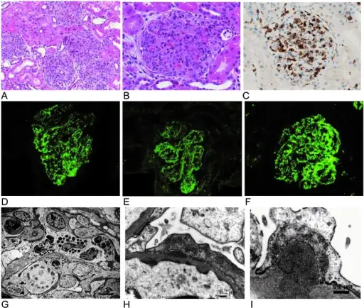 Acute Proliferative Glomerulonephritis