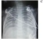 Acute Respiratory Distress Syndrome