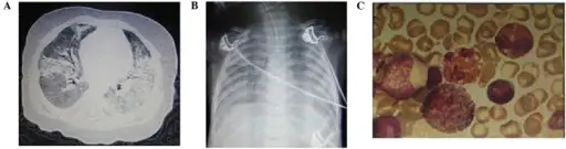 Acute Respiratory Distress Syndrome