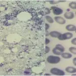 Acute immune Thrombocytopenic Purpura