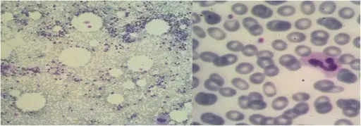 Acute immune Thrombocytopenic Purpura