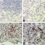 Acute on Chronic Liver Failure