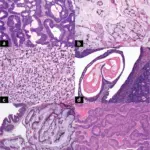 Adenocarcinoma of the Bladder