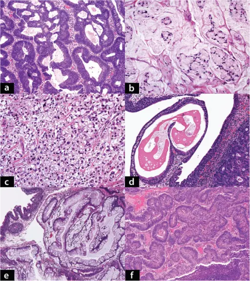 Adenocarcinoma of the Bladder