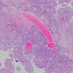 Adenocarcinoma of the Fallopian Tube