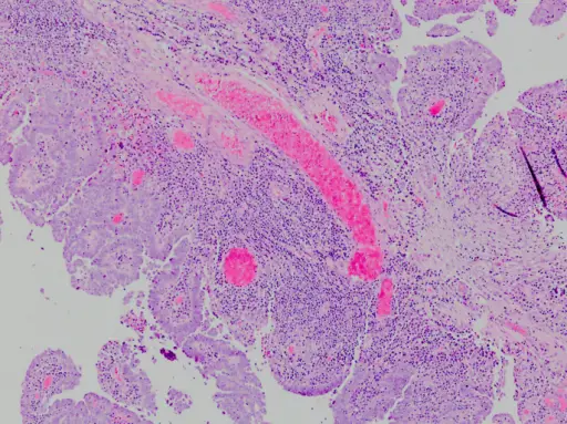 Adenocarcinoma of the Fallopian Tube