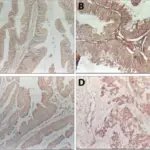 Adenocarcinoma of the Gallbladder