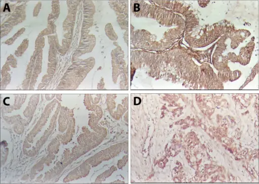 Adenocarcinoma of the Gallbladder