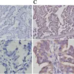 Adenocarcinoma of the Lung