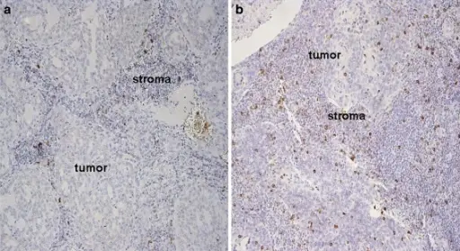 Adenocarcinoma of the Salivary Gland