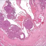 Adenomatoid Odontogenic Tumor