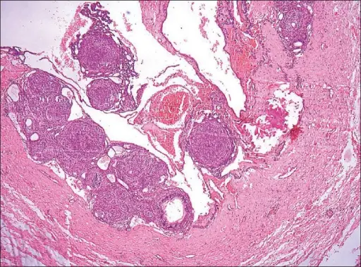 Adenomatoid Odontogenic Tumor