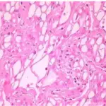 Adenomatoid Tumor