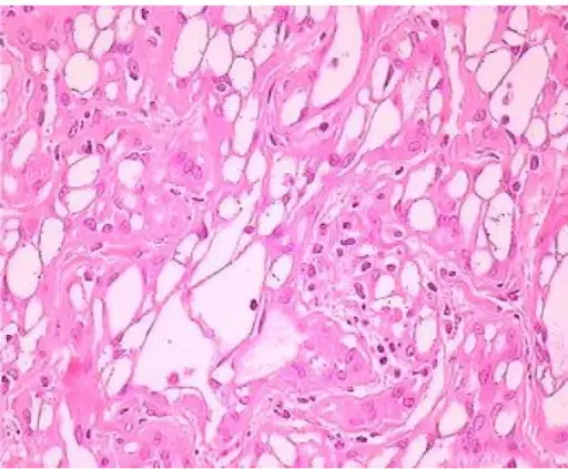 Adenomatoid Tumor