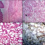 Adenomatoid Tumors