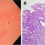 Adenomatous Polyposis