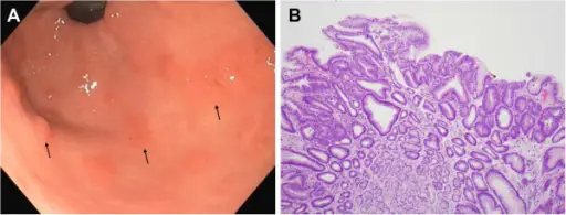 Adenomatous Polyposis