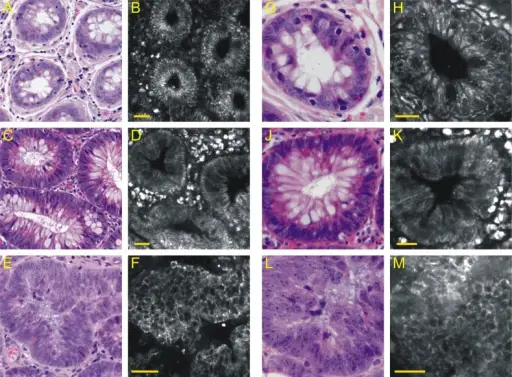 Adenomatous Polyps