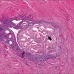 Adenomyosis