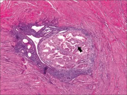 Adenomyosis