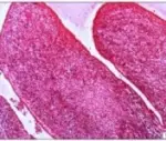 Adenosarcomas of Endometrial Stroma