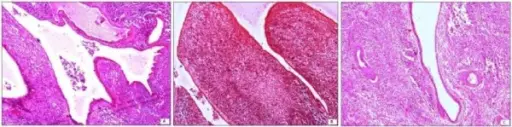 Adenosarcomas of Endometrial Stroma