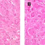 Adenosquamous Carcinoma of the Gallbladder