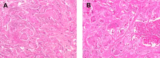 Adenosquamous Carcinoma of the Gallbladder