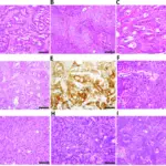 Adenosquamous Carcinoma of the Lung