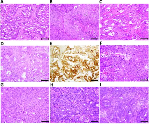 Adenosquamous Carcinoma of the Lung