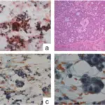 Adnexal Tumors