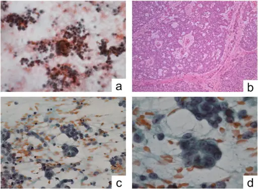 Adnexal Tumors