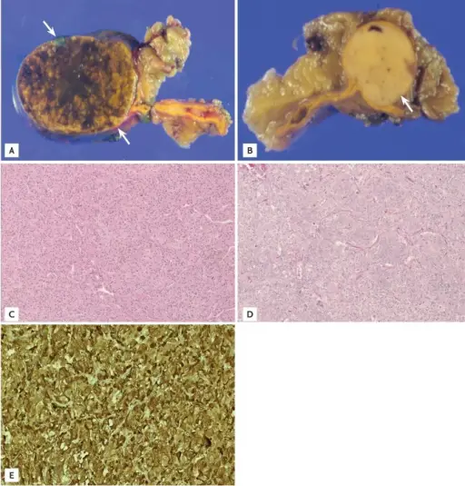 Adrenocortical Adenomas